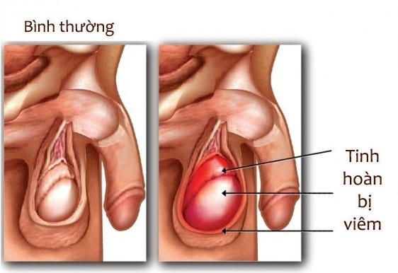 Viêm tinh hoàn - Ảnh minh họa 4