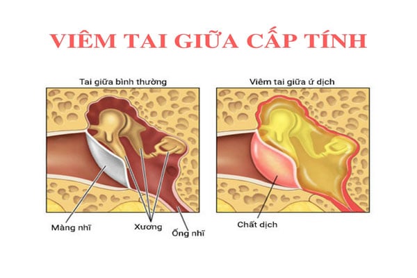 Viêm tai giữa cấp tính - Ảnh minh họa 3