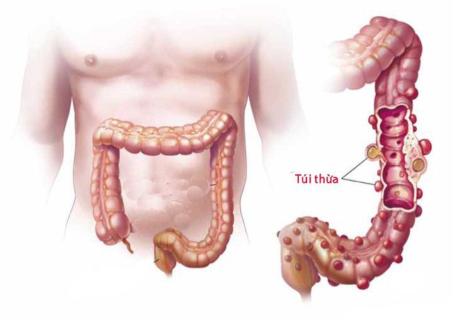 Viêm túi thừa - Ảnh minh họa 1