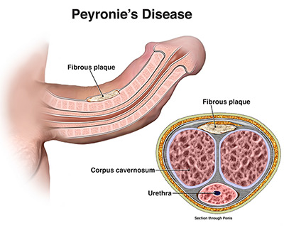 Peyronie - Ảnh minh họa 4