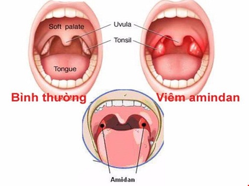 Phì đại amidan - Ảnh minh họa 1