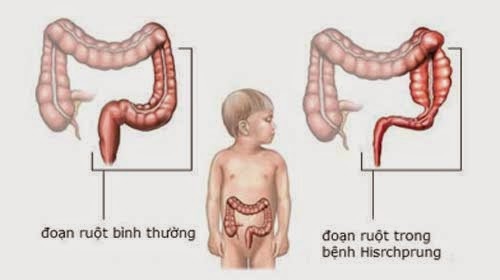 Phình đại tràng bẩm sinh - Ảnh minh họa 2