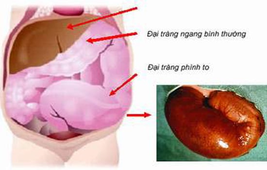 Phình đại tràng bẩm sinh - Ảnh minh họa 3