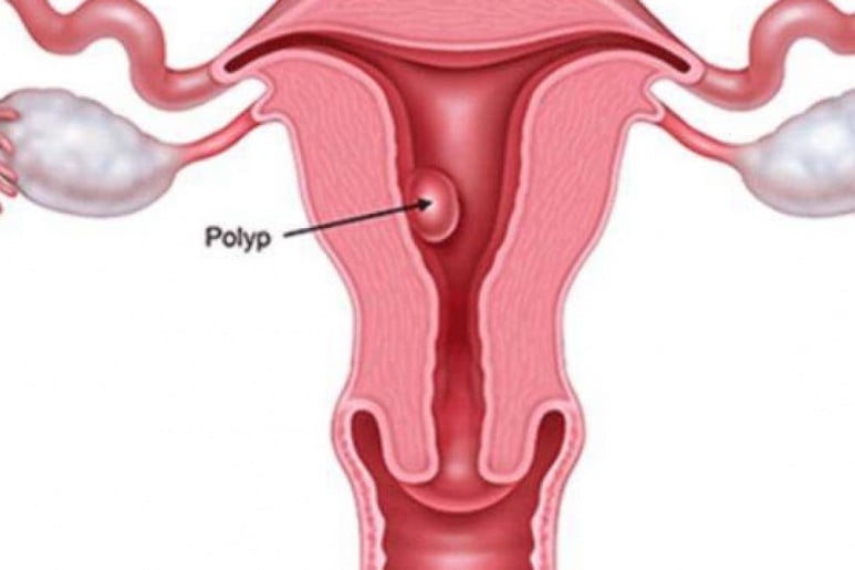 Polyp tử cung - Ảnh minh họa 1