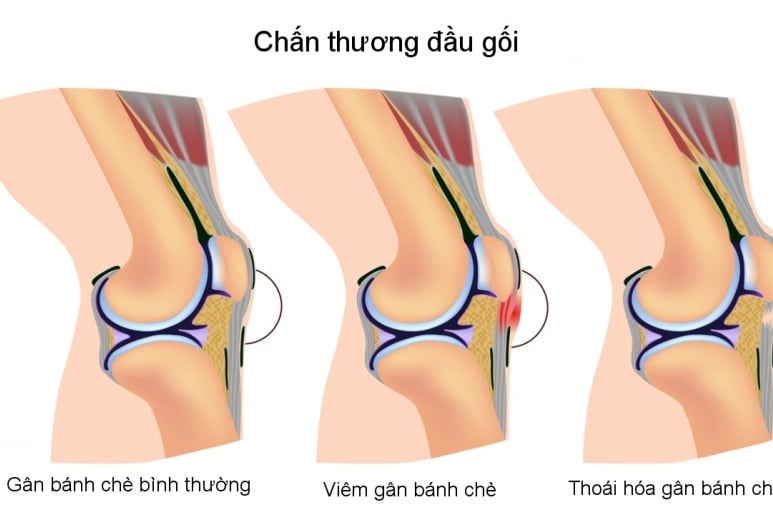 Viêm gân xương bánh chè - Ảnh minh họa 2