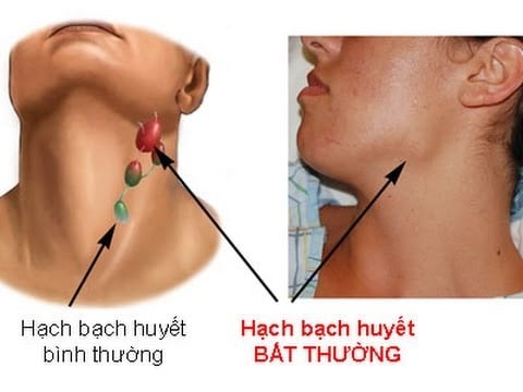 Viêm hạch bạch huyết mãn tính - Ảnh minh họa 3