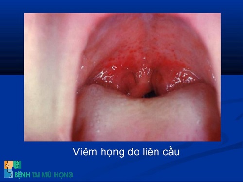 Viêm họng do liên cầu khuẩn - Ảnh minh họa 2