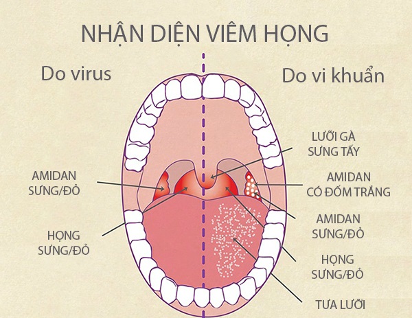 Viêm họng do liên cầu khuẩn - Ảnh minh họa 4