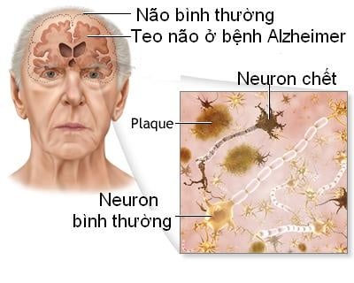 Sa sút trí tuệ - Ảnh minh họa 1