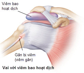 Viêm bao hoạt dịch khớp háng - Ảnh minh họa 4