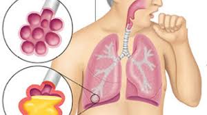 Viêm phổi do nấm - Ảnh minh họa 2