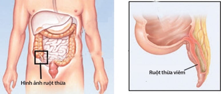 Viêm ruột thừa cấp - Ảnh minh họa 1