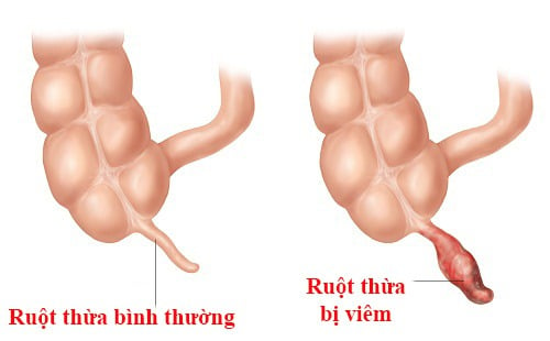 Viêm ruột thừa cấp - Ảnh minh họa 2