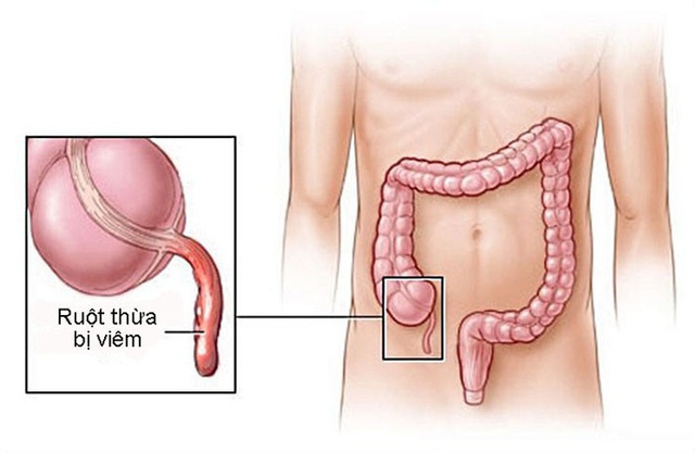 Viêm ruột thừa cấp - Ảnh minh họa 3