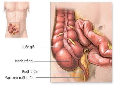 Viêm ruột thừa cấp - Ảnh minh họa 4