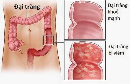 Viêm đại tràng giả mạc - Ảnh minh họa 2