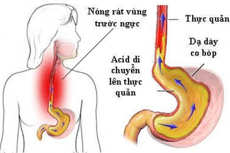 Trào ngược dạ dày thực quản - Ảnh minh họa 1