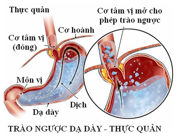 Trào ngược dạ dày thực quản - Ảnh minh họa 2