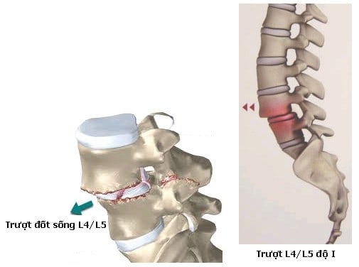 Trượt đốt sống - Ảnh minh họa 2