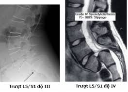 Trượt đốt sống - Ảnh minh họa 1