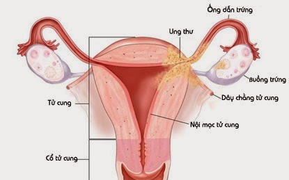 Tăng sản nội mạc tử cung - Ảnh minh họa 1