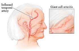 Viêm động mạch tế bào khổng lồ - Ảnh minh họa 4
