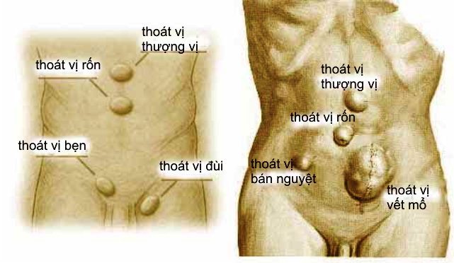 Thoát vị đùi - Ảnh minh họa 1