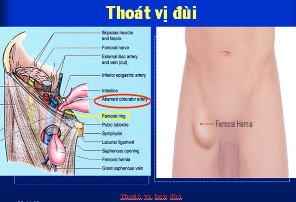 Thoát vị đùi - Ảnh minh họa 2