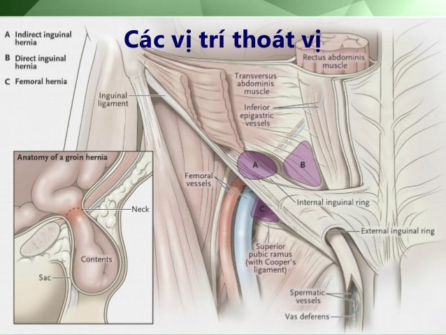 Thoát vị đùi - Ảnh minh họa 3