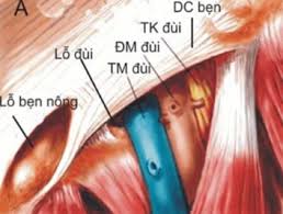 Thoát vị đùi - Ảnh minh họa 4