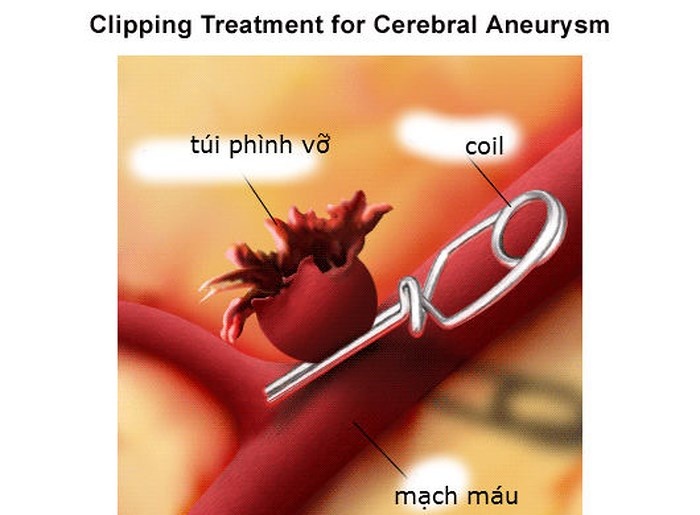 Túi phình mạch máu não - Ảnh minh họa 1