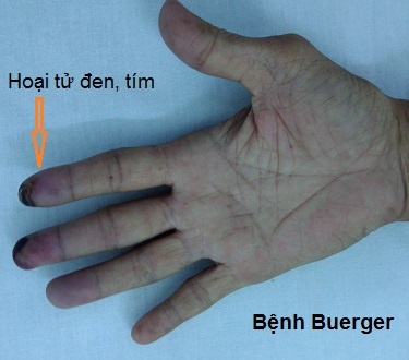 Viêm thuyên tắc mạch máu - Ảnh minh họa 3