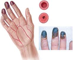 Viêm thuyên tắc mạch máu - Ảnh minh họa 4