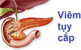 Viêm tụy cấp - Ảnh minh họa 1