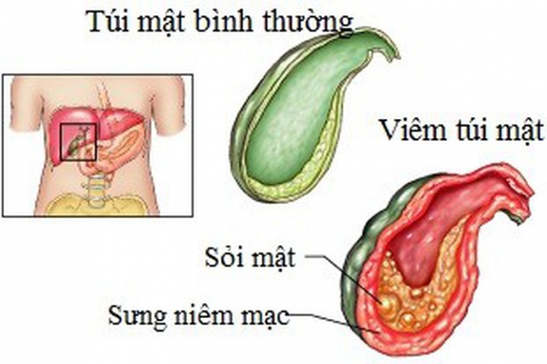 Viêm túi mật - Ảnh minh họa 2