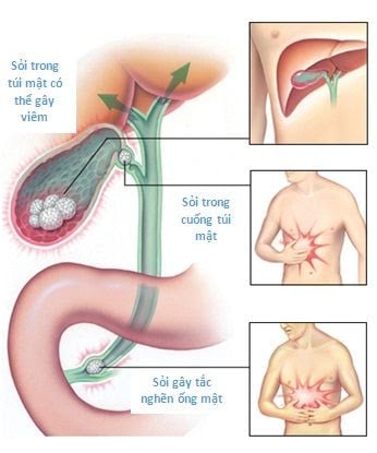 Viêm túi mật - Ảnh minh họa 3