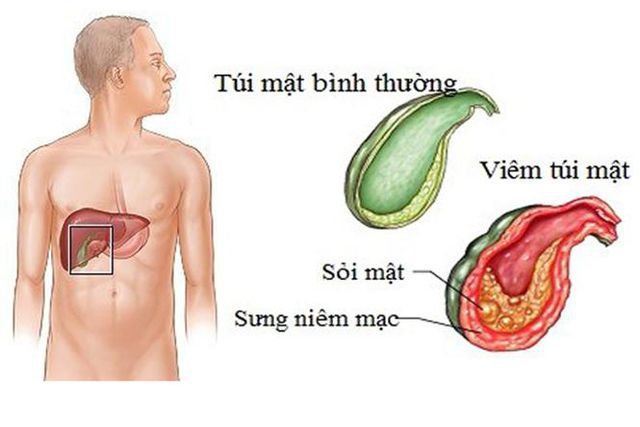 Viêm túi mật - Ảnh minh họa 4