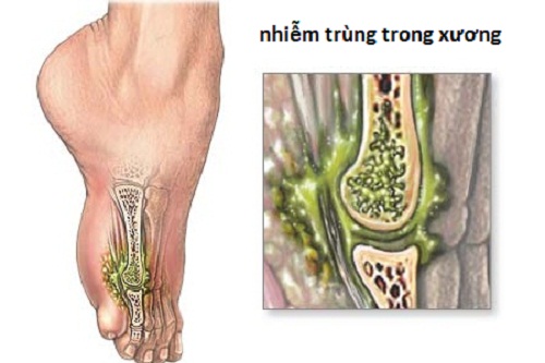 Viêm tủy xương - Ảnh minh họa 1