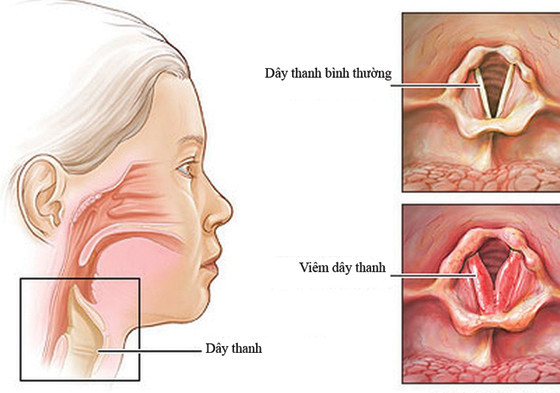 Viêm thanh khí phế quản cấp - Ảnh minh họa 4