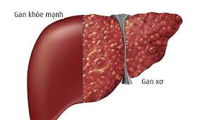Xơ gan cổ trướng - Ảnh minh họa 2