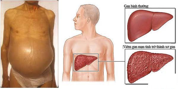 Xơ gan cổ trướng - Ảnh minh họa 4