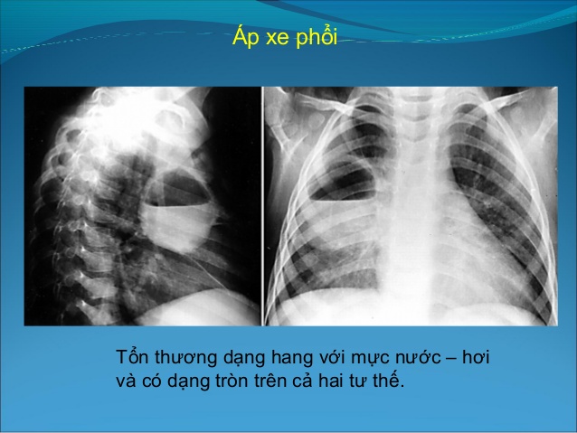 Áp xe phổi - Ảnh minh họa 1