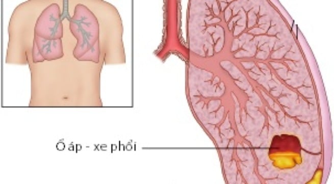 Áp xe phổi - Ảnh minh họa 2