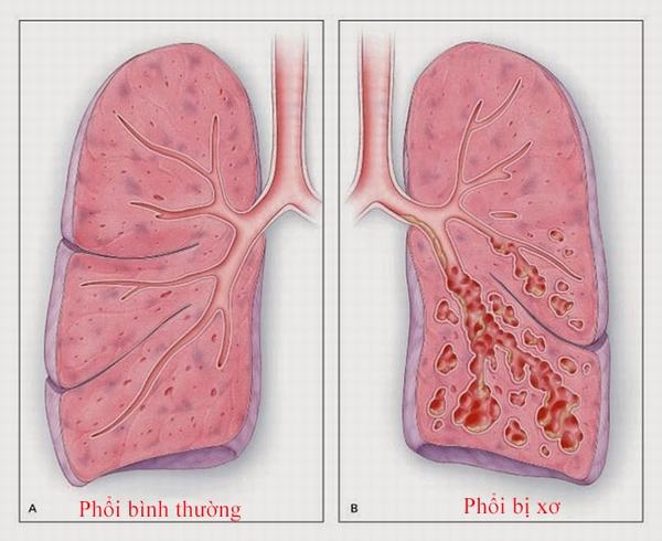 Xơ phổi - Ảnh minh họa 2