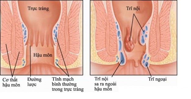 Đau hậu môn - Ảnh minh họa 4