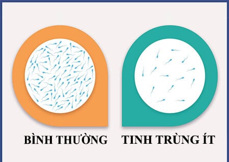 Ít tinh trùng - Ảnh minh họa 2