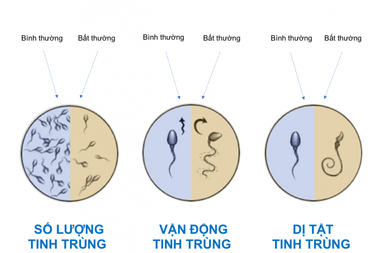 Ít tinh trùng - Ảnh minh họa 3