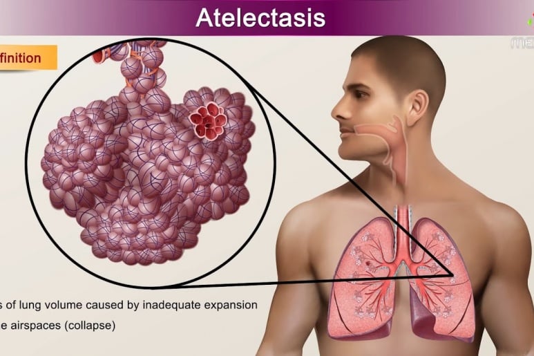 Atelectasis - Ảnh minh họa 1