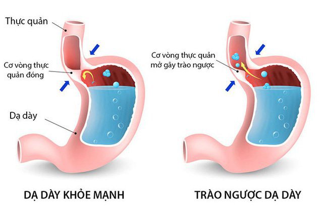 Những biểu hiện của bệnh trào ngược thực quản
