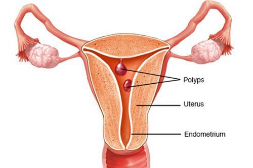 Polyp cổ tử cung